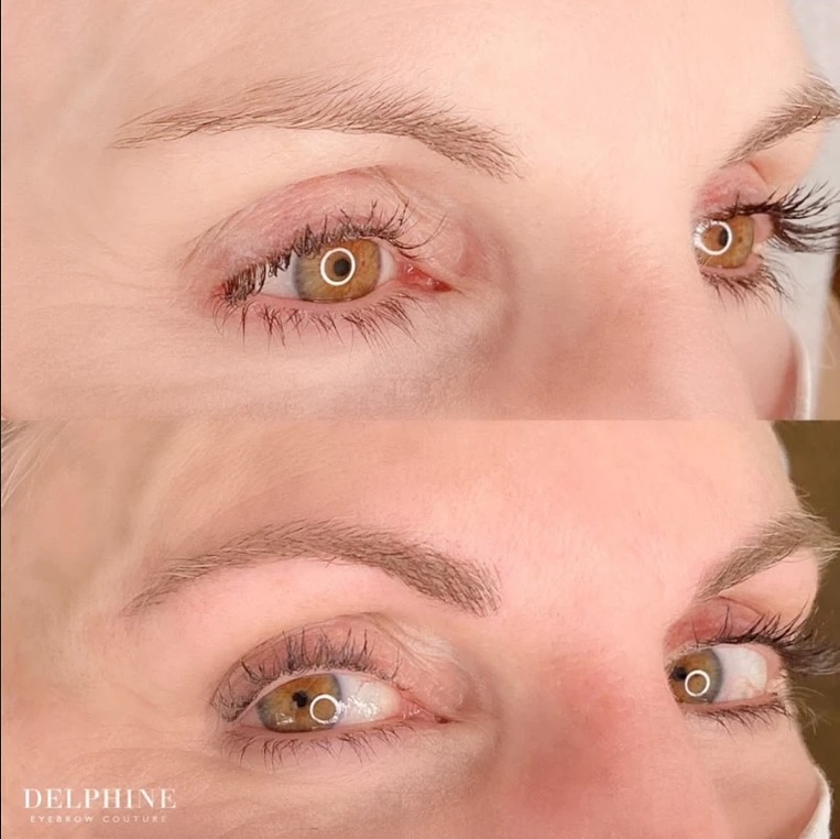 Eyebrow restoration by Delphine