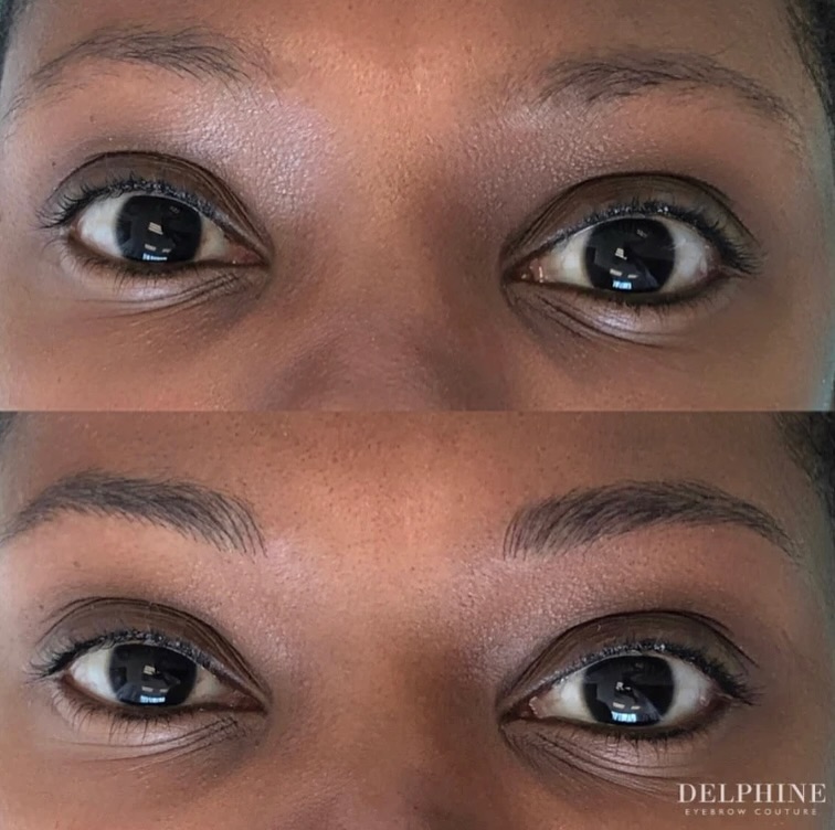 Eyebrow restoration by Delphine