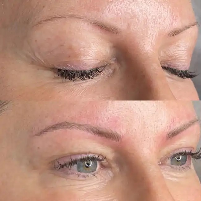 Eyebrow restoration by Delphine