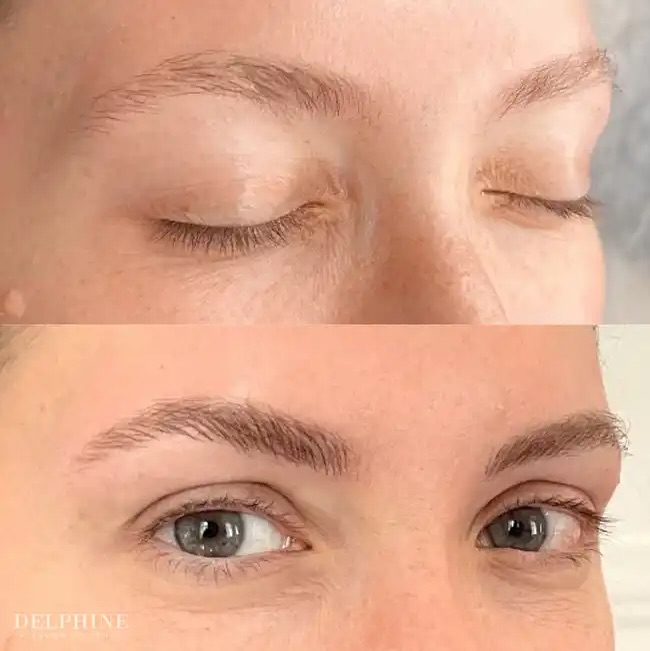 Eyebrow restoration by Delphine